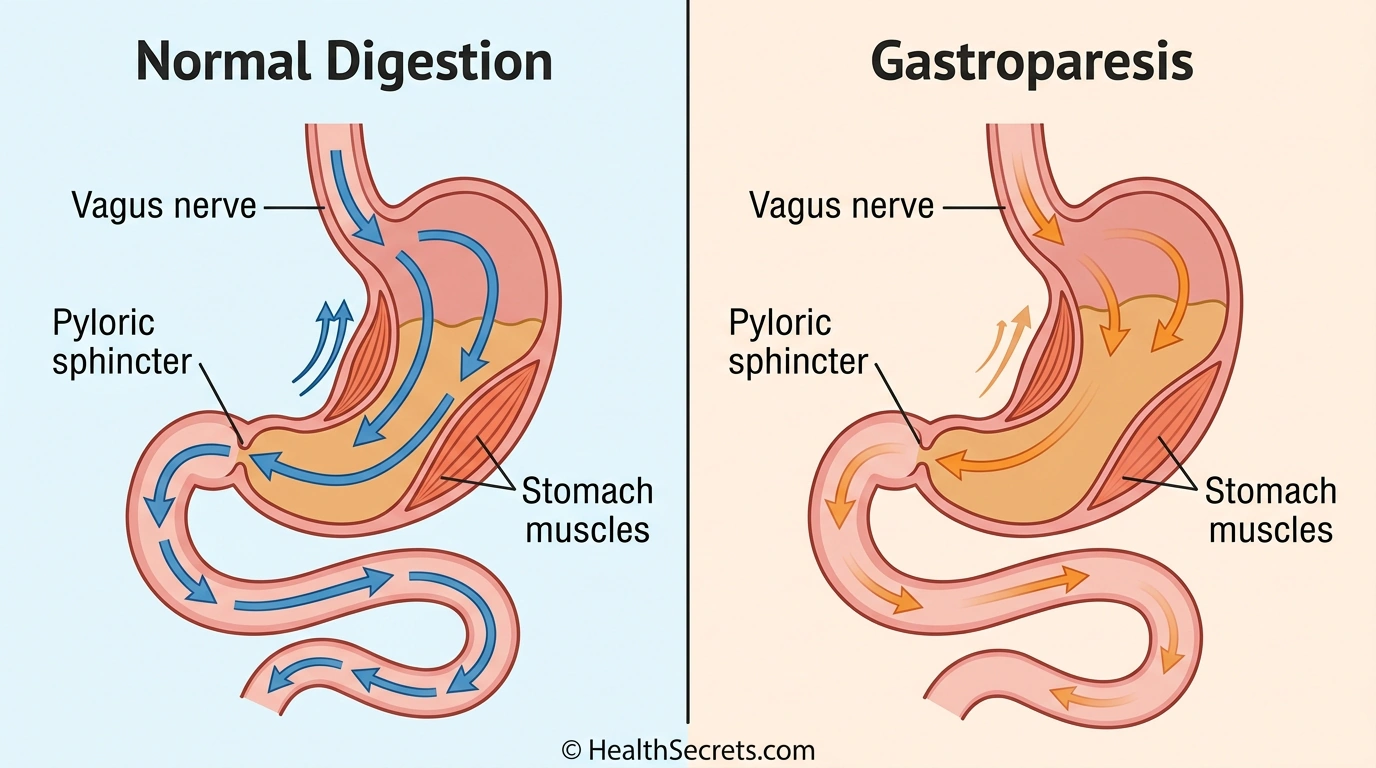 Medical infographic comparing normal gastric emptying versus delayed gastric emptying in gastroparesis