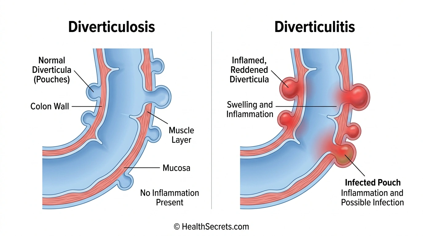 Medical diagram comparing diverticulosis showing normal colon pouches versus diverticulitis showing inflamed infected diverticula