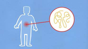 Rheumatoid Arthritis 101: Understanding the Symptoms, Causes, and Treatment Options