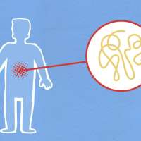 Flare-ups and Remissions: The Rollercoaster of Ulcerative Colitis