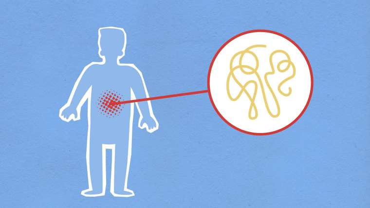 Flare-ups and Remissions: The Rollercoaster of Ulcerative Colitis