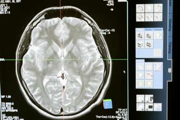 Grave Consequences: Understanding the Impact of Graves Disease on Your Health