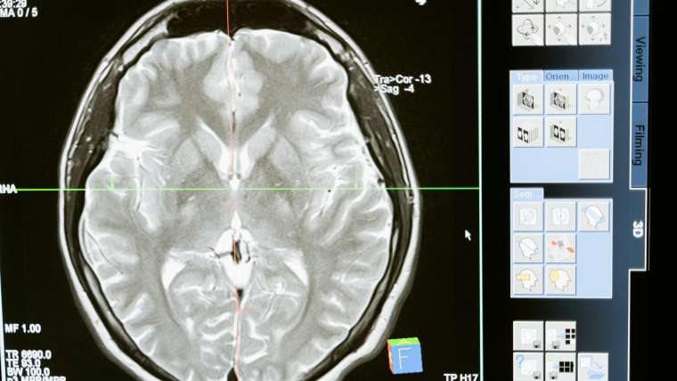 Grave Consequences: Understanding the Impact of Graves Disease on Your Health