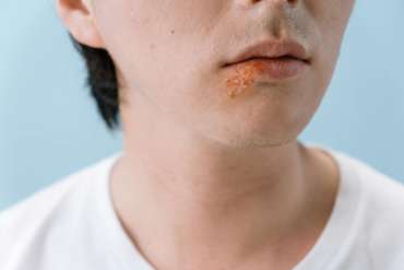 The Truth About Cold Sores: What You Need to Know and How to Get Rid of Them