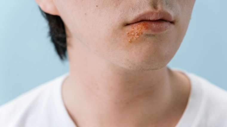 The Truth About Cold Sores: What You Need to Know and How to Get Rid of Them