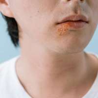 Kiss Cold Sores Goodbye: Effective Remedies and Tips to Heal Fast